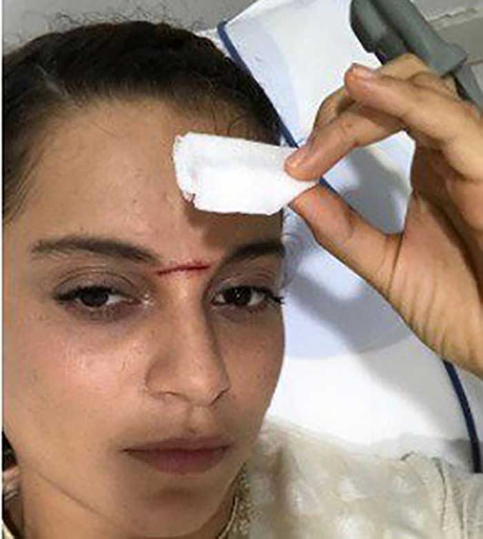 Kangana got a deep cut on her forehead