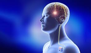  Deep brain stimulation (DBS)