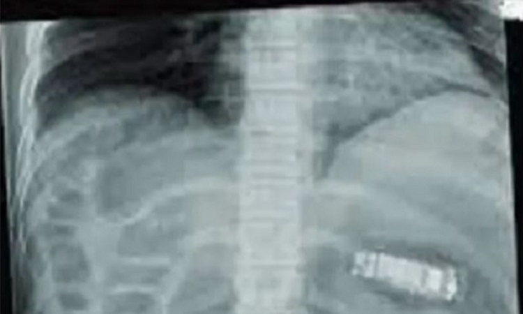 Inmate's x-ray shows mobile in his stomach